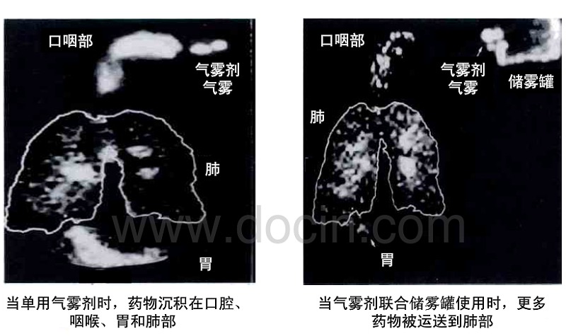 氣霧劑結(jié)合氣霧罐使用時(shí)治療效果更佳